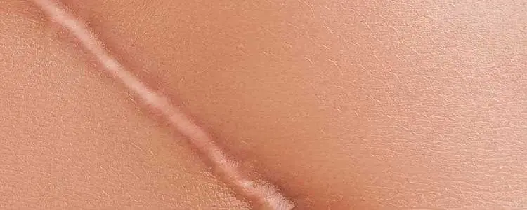 Scar Revision