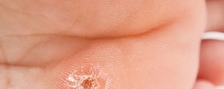 Skin Tags and Warts
