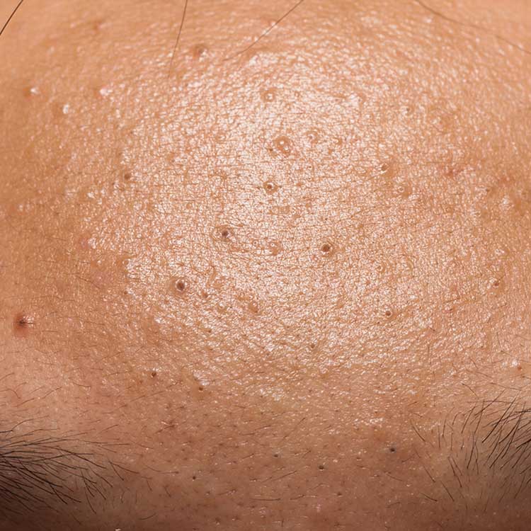 Enlarged Pores