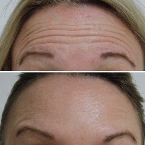 Botox Example 02