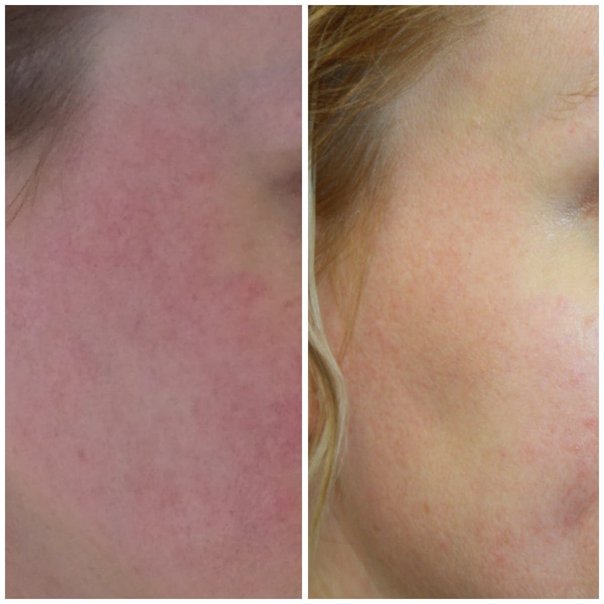 Relieve symptoms of Rosacea with Dermalux LED phototherapy! The