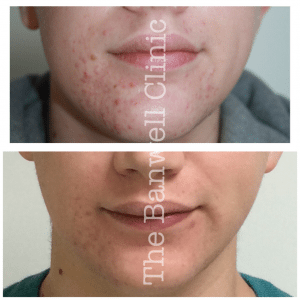 Acne and congestion