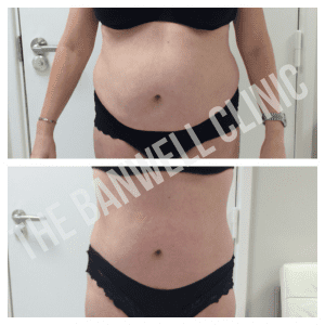 3D-lipo at The Banwell Clinic