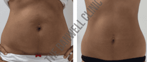 3D-lipo cavitation with The Banwell clinic